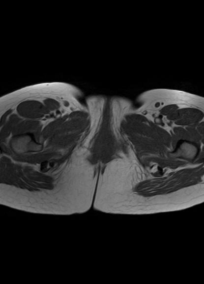 File:Aggressive angiomyxoma of the pelvis and perineum (Radiopaedia 59162-66479 T1 2).jpg