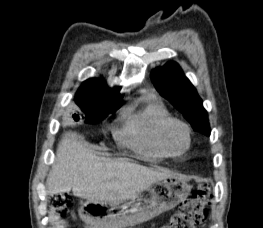Airway foreign body in adult (Radiopaedia 85907-101779 Coronal liver window 36).jpg