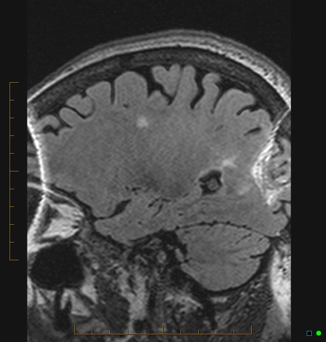 Aliasing artifact causing a spurious cerebellar lesion (Radiopaedia 48783-53810 Sagittal FLAIR 2).jpg