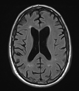 File:Alzheimer's disease- with Gerstmann syndrome and dressing apraxia (Radiopaedia 54882-61150 Axial FLAIR 17).png