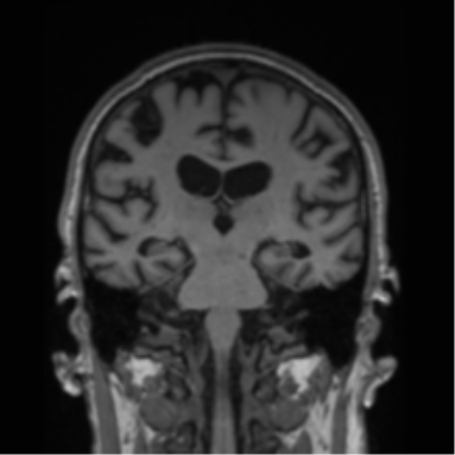 Alzheimer's disease- with Gerstmann syndrome and dressing apraxia (Radiopaedia 54882-61150 Coronal T1 40).png