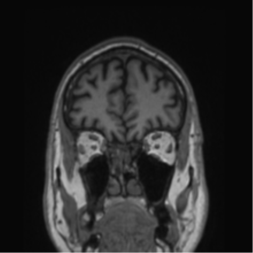 Alzheimer's disease- with Gerstmann syndrome and dressing apraxia (Radiopaedia 54882-61150 Coronal T1 74).png