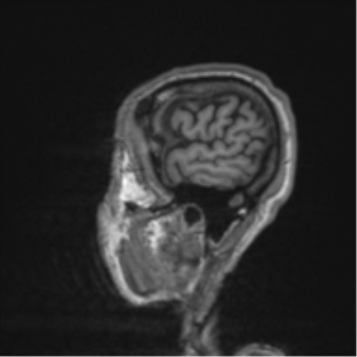 File:Alzheimer's disease- with apraxia (Radiopaedia 54763-61011 Sagittal T1 6).png