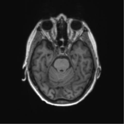 File:Alzheimer's disease (Radiopaedia 42658-45802 Axial T1 104).png