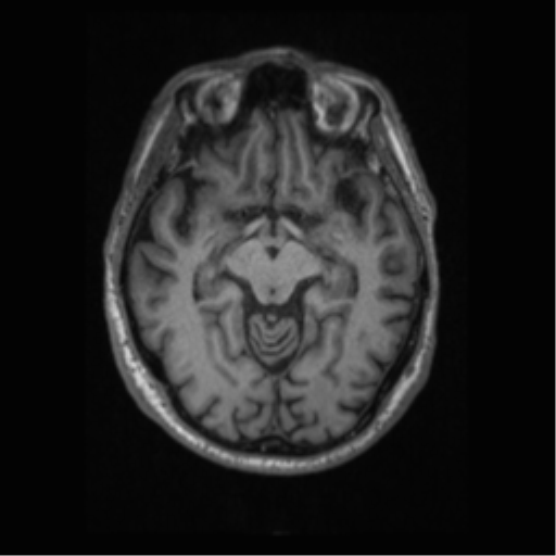 Alzheimer disease - probable (Radiopaedia 35334-36837 Axial T1 34).png