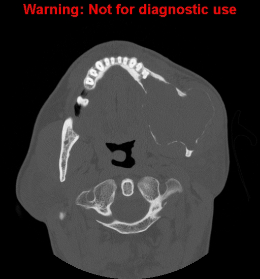 File:Ameloblastoma (Radiopaedia 13276-13280 Axial non-contrast 12).jpg