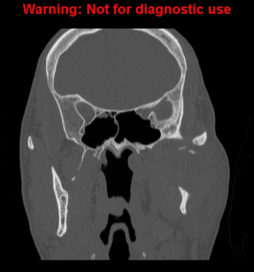 File:Ameloblastoma (Radiopaedia 13276-13280 Coronal non-contrast 16).jpg