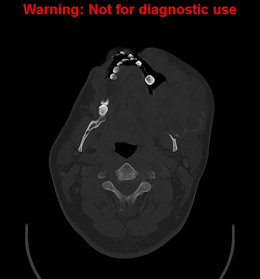 Ameloblastoma (Radiopaedia 33126-34164 Axial bone window 12).jpg