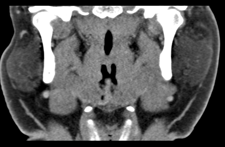 Ameloblastoma (Radiopaedia 33677-34806 Coronal non-contrast 38).png