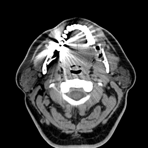 Ameloblastoma (Radiopaedia 38520-40623 Axial non-contrast 28).png