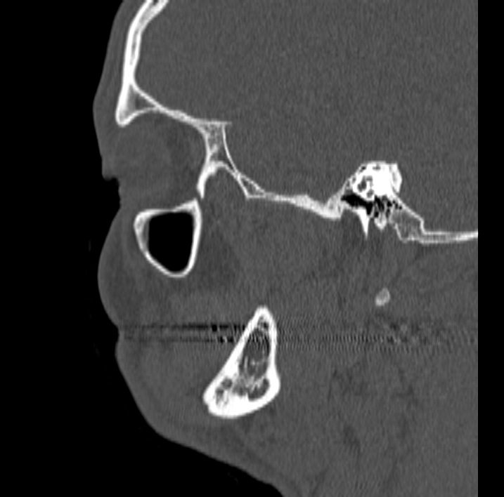 Ameloblastoma (Radiopaedia 77750-89997 Sagittal bone window 76).jpg