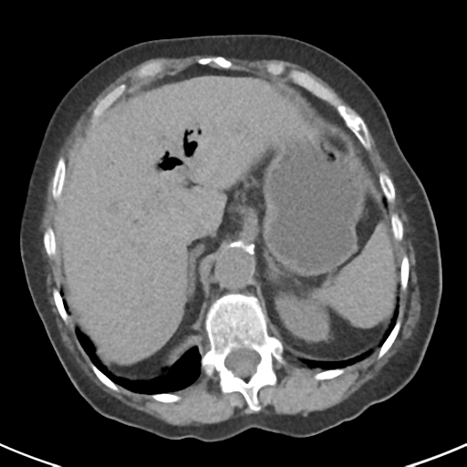 File:Ampullary adenocarcinoma (Radiopaedia 34013-35237 Axial non-contrast 11).png