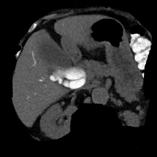 Ampullary adenocarcinoma (Radiopaedia 34013-35241 AXIAL MIPS 3-1.5 47).png