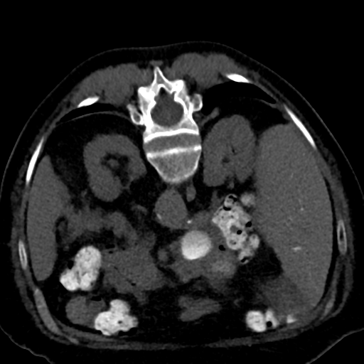 Ampullary adenocarcinoma (Radiopaedia 34013-35241 C 39).png