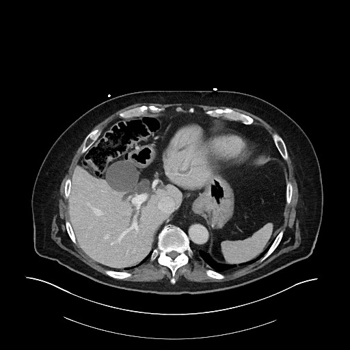 Ampullary adenocarcinoma (Radiopaedia 59373-66734 C 36).jpg