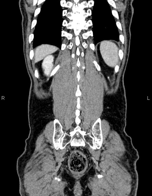 Ampullary adenocarcinoma (Radiopaedia 86093-102032 C 59).jpg