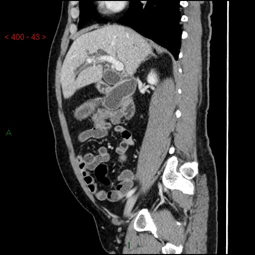 Ampullary carcinoma (Radiopaedia 56396-63056 D 42).jpg