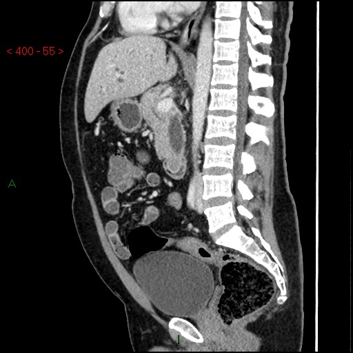 File:Ampullary carcinoma (Radiopaedia 56396-63056 D 54).jpg