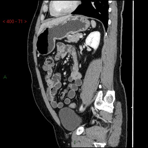 Ampullary carcinoma (Radiopaedia 56396-63056 D 70).jpg