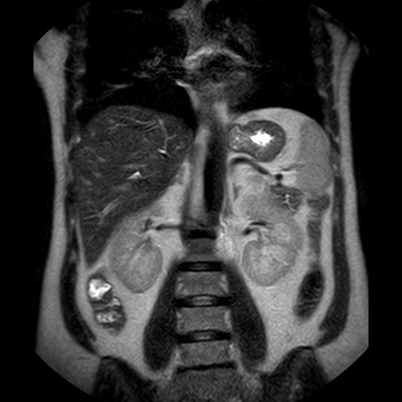 File:Ampullary tumor (Radiopaedia 27294-27479 Coronal T2 16).jpg