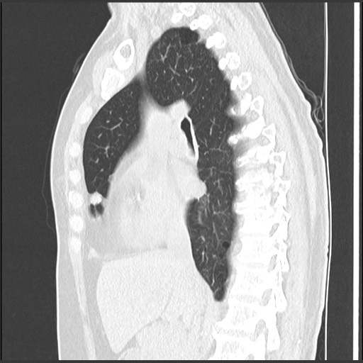 Amyloidosis - bronchial and diffuse nodular pulmonary involvement (Radiopaedia 60156-67744 F 25).jpg