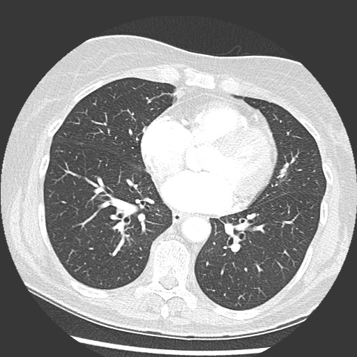 Amyloidosis - bronchial and diffuse nodular pulmonary involvement (Radiopaedia 60156-67745 Axial lung window 52).jpg