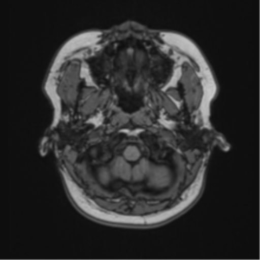 Anaplastic astroblastoma (Radiopaedia 55666-62194 Axial T1 7).png