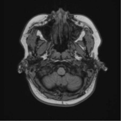 File:Anaplastic astroblastoma (Radiopaedia 55666-62194 Axial T1 8).png