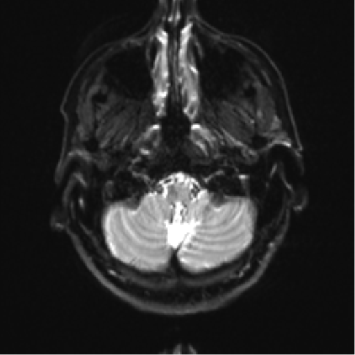 Anaplastic astrocytoma - thalamic glioma (Radiopaedia 59709-67115 Axial DWI 4).png