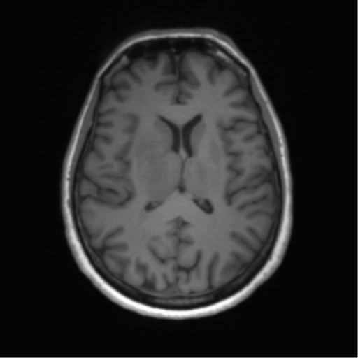 File:Anaplastic astrocytoma - thalamic glioma (Radiopaedia 59709-67115 Axial T1 20).png