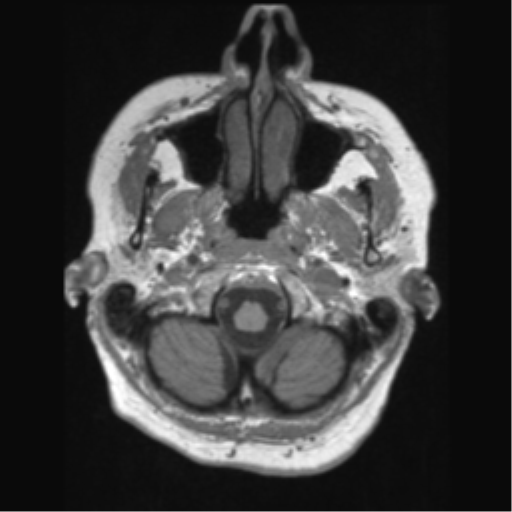 File:Anaplastic astrocytoma IDH wild-type (pseudoprogression) (Radiopaedia 42209-45276 Axial T1 21).png