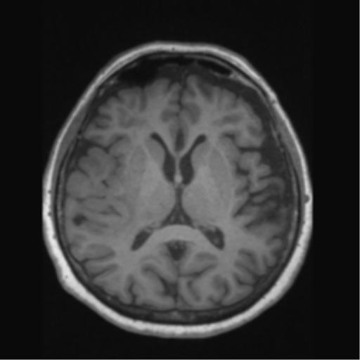 Anaplastic astrocytoma IDH wild-type (pseudoprogression) (Radiopaedia 42209-45276 Axial T1 84).png