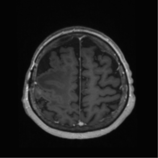 File:Anaplastic astrocytoma IDH wild-type (pseudoprogression) (Radiopaedia 42209-45278 Axial T1 C+ 119).png