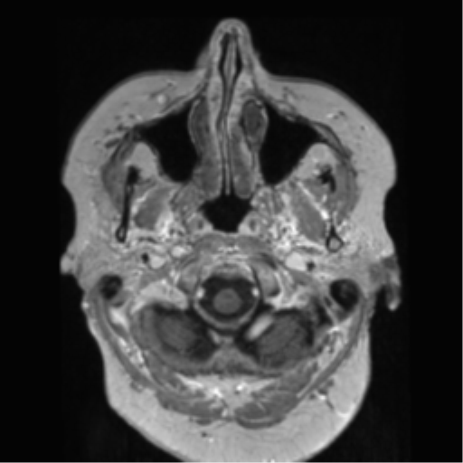 Anaplastic astrocytoma IDH wild-type (pseudoprogression) (Radiopaedia 42209-45278 Axial T1 C+ 23).png