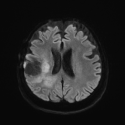 Anaplastic astrocytoma IDH wild-type (pseudoprogression) (Radiopaedia 42209-45279 Axial DWI 44).png
