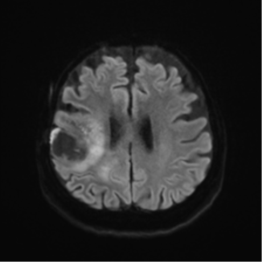 Anaplastic astrocytoma IDH wild-type (pseudoprogression) (Radiopaedia 42209-45279 Axial DWI 45).png