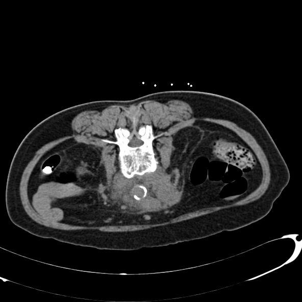 File:Anaplastic lymphoma - with CT biopsy (Radiopaedia 21643-21602 Axial non-contrast 43).jpg