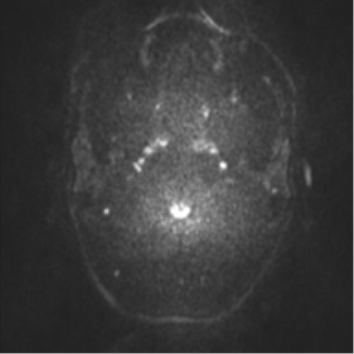 Anaplastic oligodendroglioma (Radiopaedia 37667-39563 Axial DWI 41).png