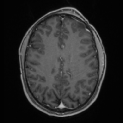 Anaplastic oligodendroglioma with skull fracture (Radiopaedia 74831-85845 Axial T1 C+ fat sat 42).png