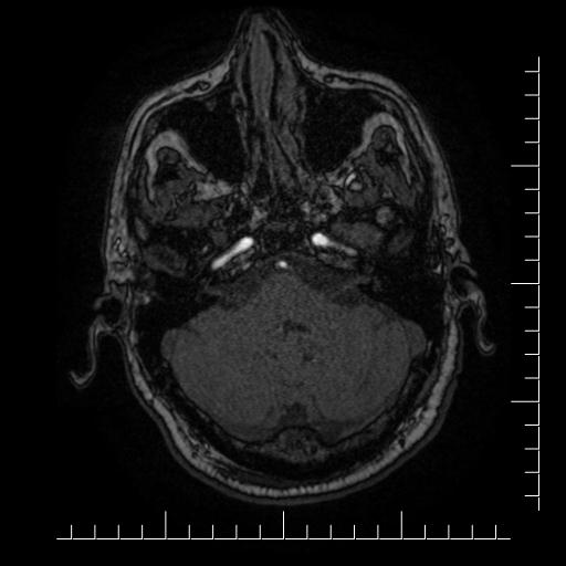 File:Aneurysm of posterior communicating artery (Radiopaedia 20188-20163 Axial MRA 57).jpg
