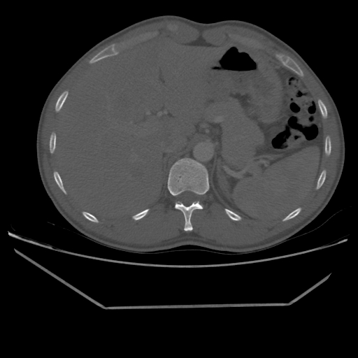 Aneurysmal bone cyst - rib (Radiopaedia 82167-96220 Axial bone window 241).jpg