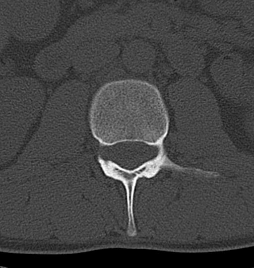 Aneurysmal bone cyst T11 (Radiopaedia 29294-29721 Axial bone window 78).jpg