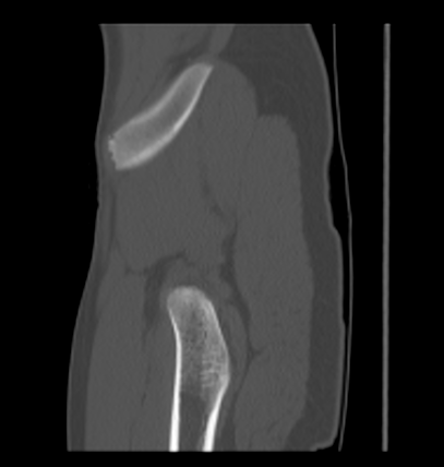 Aneurysmal bone cyst of ischium (Radiopaedia 25957-26094 Sagittal bone window 64).png