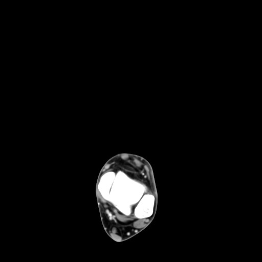 File:Aneurysmal bone cyst of the calcaneus (Radiopaedia 60669-68421 A 14).jpg