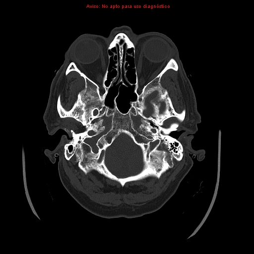 File:Aneurysmal subarachnoid hemorrhage (Radiopaedia 24740-24997 bone window 6).jpg