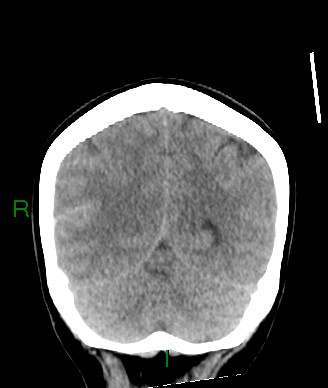 Aneurysmal subarachnoid hemorrhage with intra-axial extension (Radiopaedia 84371-99699 Coronal non-contrast 21).jpg