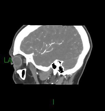 Aneurysmal subarachnoid hemorrhage with intra-axial extension (Radiopaedia 84371-99732 B 15).jpg