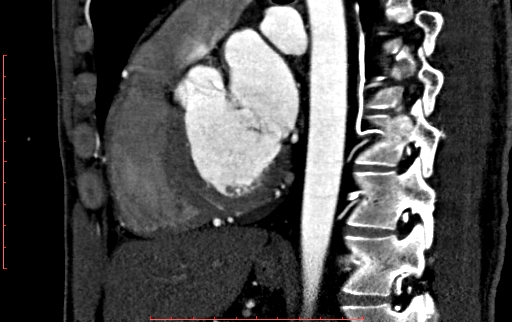 Anomalous left coronary artery from the pulmonary artery (ALCAPA) (Radiopaedia 70148-80181 C 138).jpg