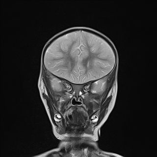 File:Anoxic brain injury (Radiopaedia 79165-92139 Coronal T2 9).jpg
