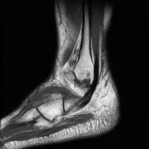 File:Anterior calcaneal process fracture (Radiopaedia 71377-81705 Sagittal T1 3).jpg